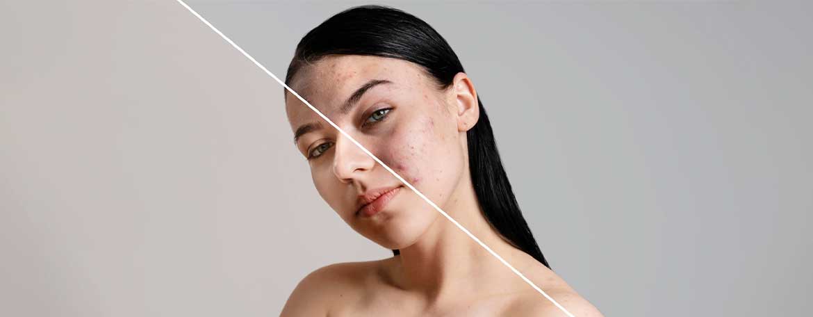 Fungal-Acne-How-to-Identify-and-Treat-All-In-A-Glance